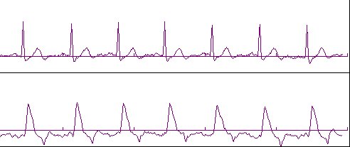 Sample HIC Waveform